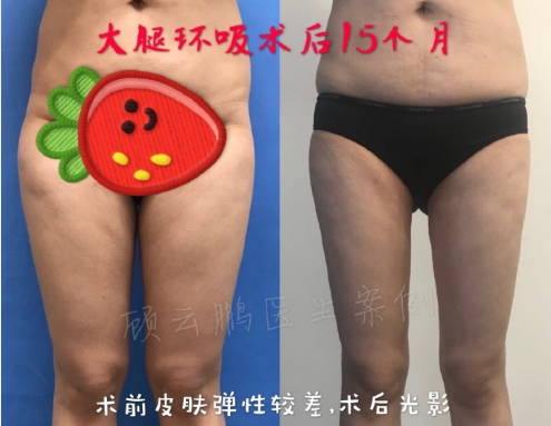 顾云鹏大腿环吸案例